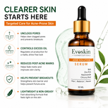 Acne Solution Face Serum 30 ml